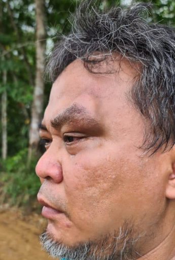 Luka di pelipis mata Camat Tenggarong Arfan Boma setelah mengusir aktivitas tambang ilegal di wilayahnya, Minggu 9/5/2021).