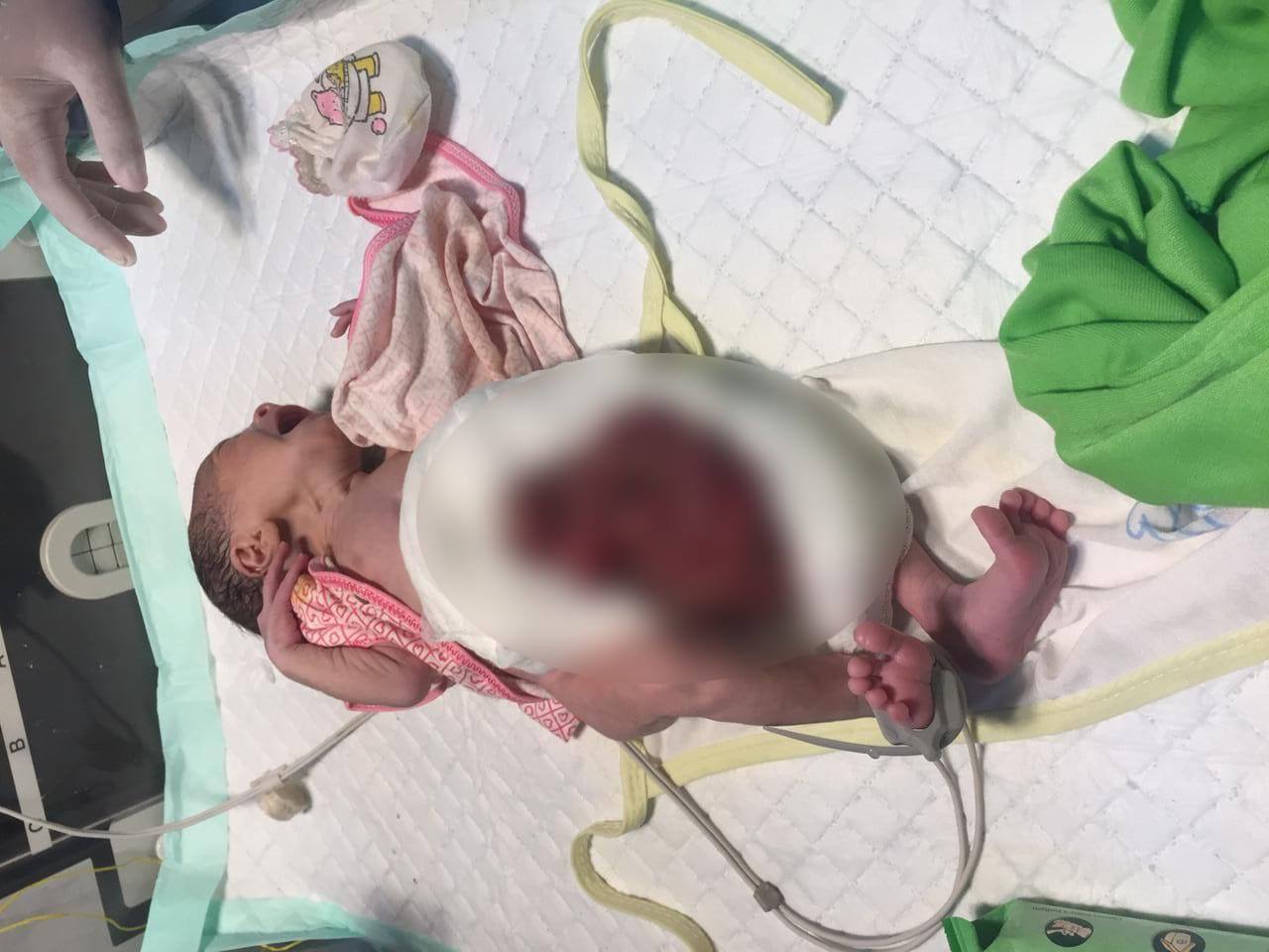 Bayi di Sangkulirang Lahir Tanpa Dinding Perut, Pemerintah Respon Cepat Tangani Biaya Operasi