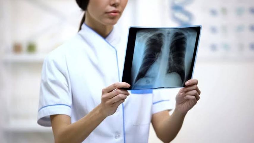 Dinkes Kaltim Akui Terkendala Deteksi Kasus TBC karena Keterbatasan Alat Tes