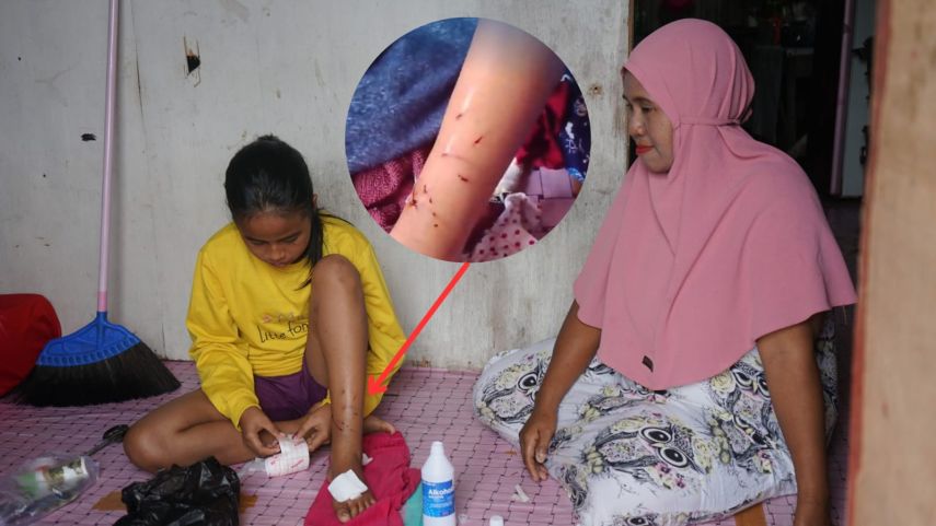 Remaja 14 Tahun Diterkam Buaya, Korban Alami Luka Sobek