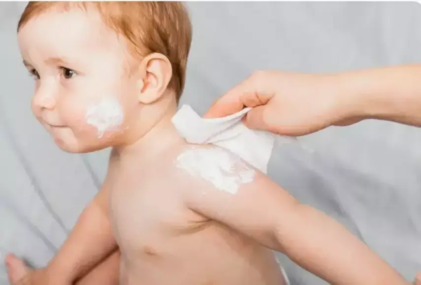 Mitos atau Fakta: Anak Terkena Campak dan Cacar Tidak Boleh Mandi? Ini Penjelasan Dokter