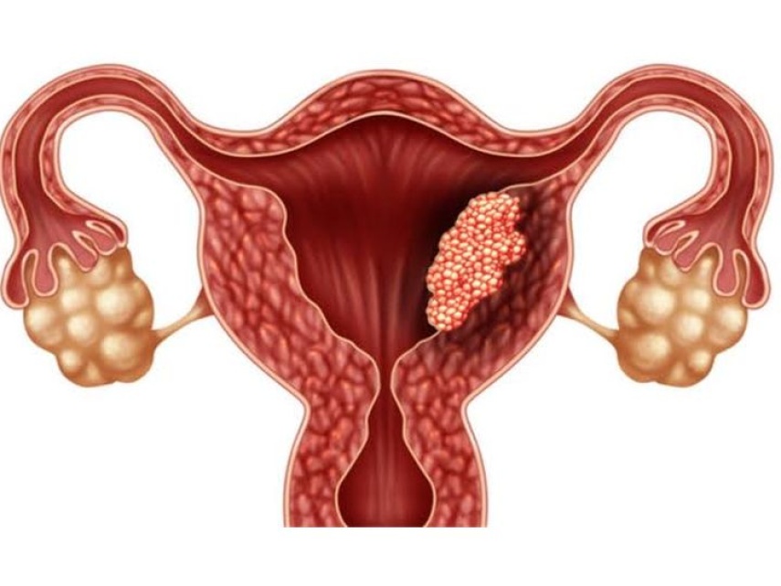 Cegah Kanker Serviks: Cek Estimasi Biaya dan Waktu Terbaik Vaksinasi HPV